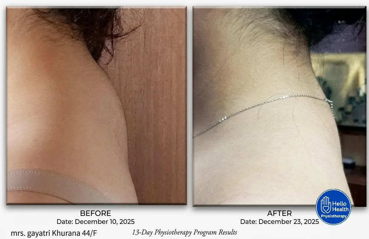 Patient physiotherapy before and after result